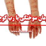 تأثیر رب گوجه‌فرنگی بر سوختگی
