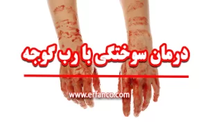 تأثیر رب گوجه‌فرنگی بر سوختگی